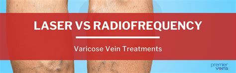 Treating Varicose Veins With Laser Vs Rfa Premier Veins Birmingham