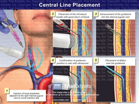 Insertion Of Central Line Venous Catheter Trial Exhibits Off