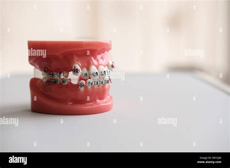 Dental Casting Model Human Jaws With Braces In Prosthetic Laboratory