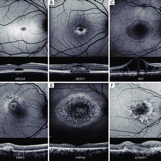 Retinal Imaging Of Rod Cone Dystrophies A Autosomal Dominant