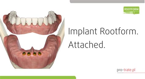 Roott R Pro Trate Implants Roott