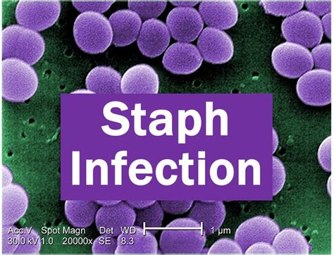 What Is A Staph Infection Causes Treatment And Complications