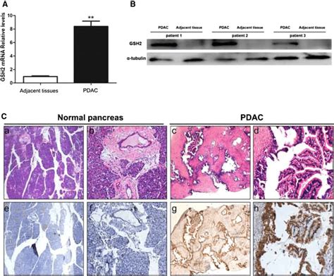 GSH2 Overexpressed In Human Pancreatic Cancer Tissues A QRT PCR On