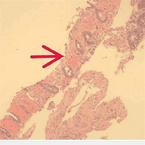 Colon Biopsy Hematoxylin And Eosin Stain 10x Red Arrow Showing Download Scientific Diagram