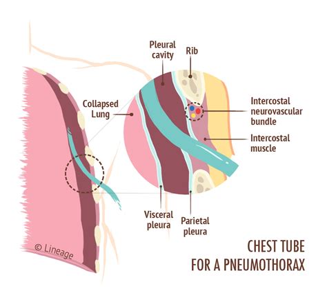 Spontaneous Pneumothorax Tracheal Deviation