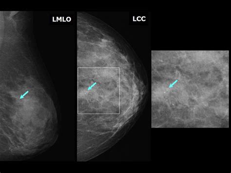 Atlas Of Breast Cancer Early Detection