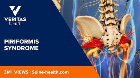 Piriformis Syndrome Causes