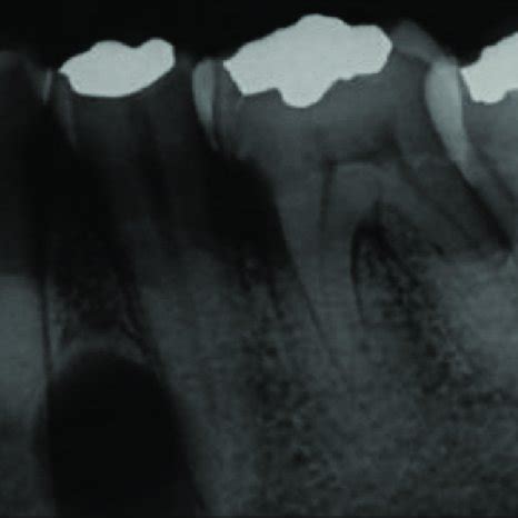 Pre-operative periapical radiograph. Note welldemarcated radiolucency ...