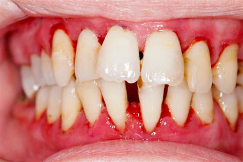 Gum Disease Gingivitis Symptoms Causes And Treatment Pure Medical