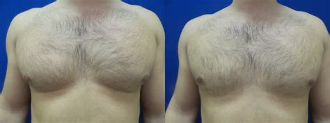 Gynecomastia Photo Gallery