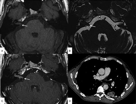 A Noncontrast Axial T1 Weighted Sequence Showing An Isointense Lesion