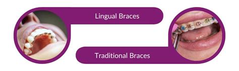 Lingual Braces Pros And Cons