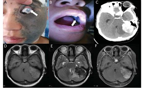 Figure 1 From Cerebellar Meningeal Melanocytoma Associated With Nevus