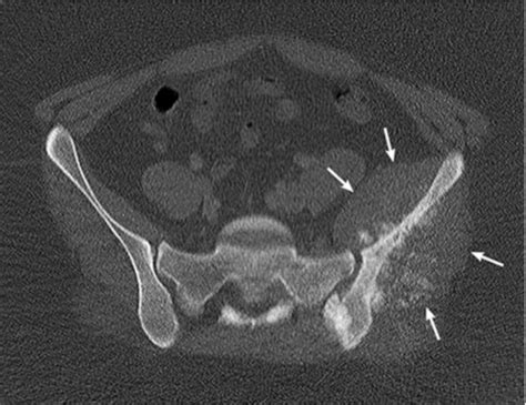 Figure 1 From Venous Tumor Thrombus From A Pelvic Osteosarcoma