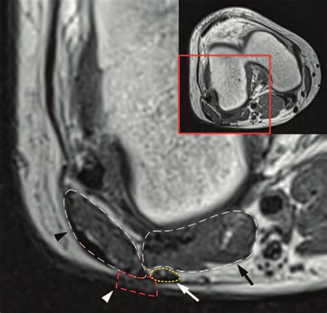 Preoperative Axial T1 Weighted Magnetic Resonance Imaging Of The Knee