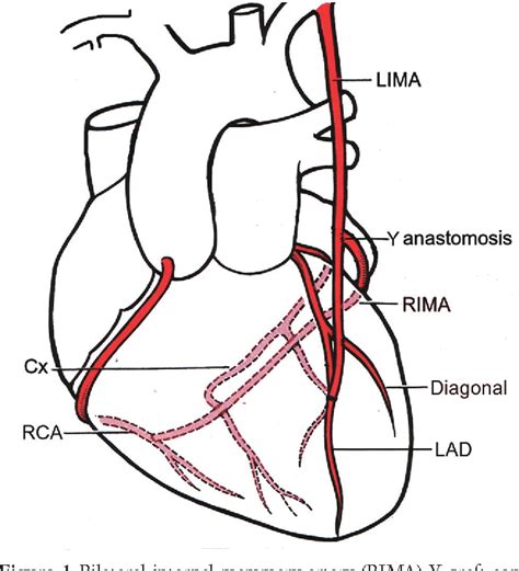 Full Myocardial Revascularization With Bilateral Internal Mammary