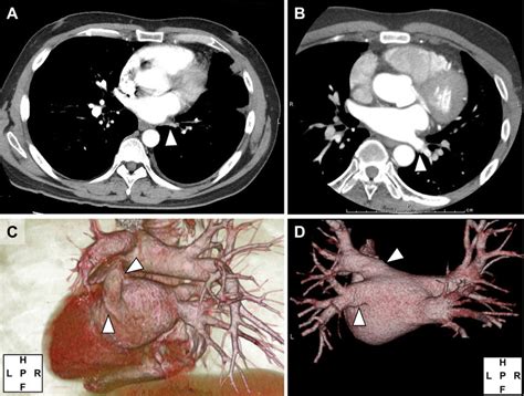 Chest contrast-enhanced CT and three-dimensional rendered CT ...