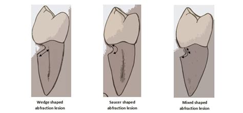 What Are Tooth Abfractions? - Pro Teeth Guard