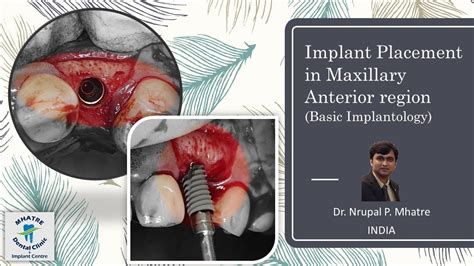 Implant Placement In Maxillary Anterior Region Basic Implantology