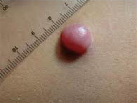 Pilomatricoma - Treatment, Pictures, Symptoms, Causes, Prognosis ...