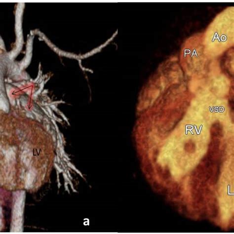 Three Dimensional Computed Tomography Reconstruction Image A Download Scientific Diagram