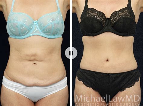 Abdominoplasty Tummy Tuck Before And After Blue Water Plastic