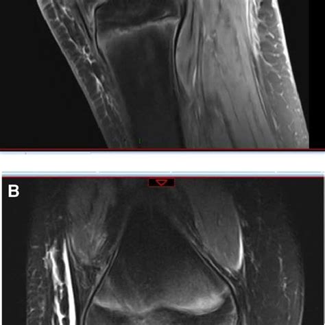 (A) An MRI scan image of the Sagittal side revealed good morphology of ...