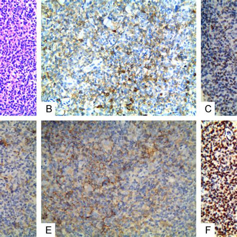 The Representation Micrographs Showing Of Follicular Lymphoma