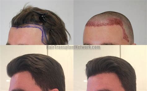 Dr H Rahal Hair Transplant Procedure Before And After Result Photos