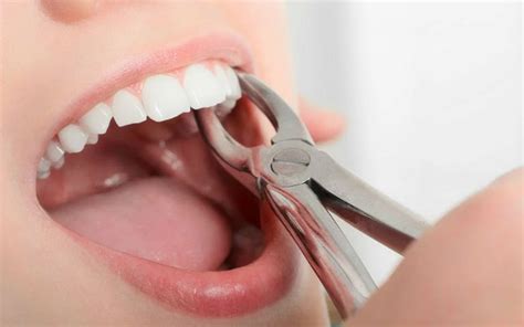 Understanding Dental Extractions And Their Impact On Adjacent Teeth