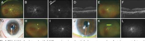 Figure 1 From Postoperative Hemorrhagic Occlusive Retinal Vasculitis