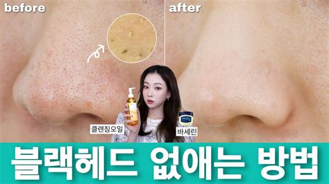 모공 커지는 이유 블랙헤드 제거하는 방법👃🏻바세린 블랙헤드 클렌징오일 Youtube