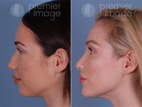 Chin Augmentation Rhinoplasty Before And After Photos Sandy Springs