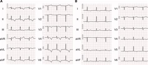 Myocarditis Ecg Changes