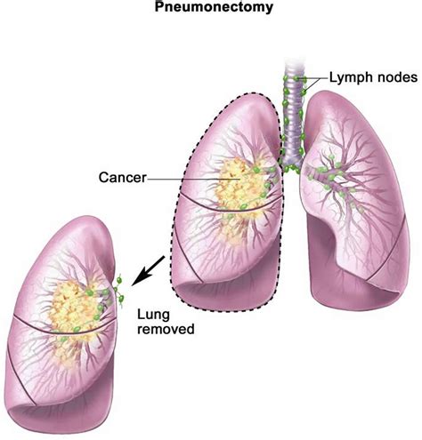 Pneumonectomy procedure, position, complications and revovery