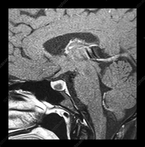 Pituitary Microadenoma MRI - Stock Image - C043/0225 - Science Photo Library