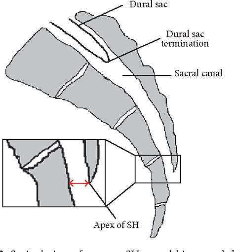 Figure 2 from Caudal Epidural Block: An Updated Review of Anatomy and ...