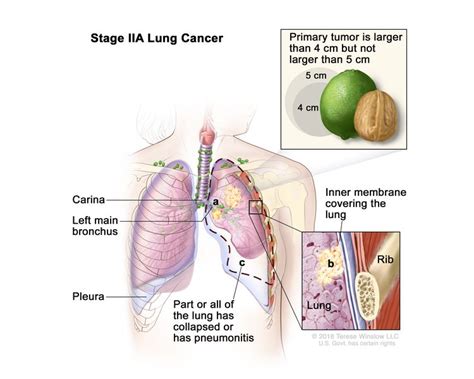 Non-Small Cell Lung Cancer | Vanderbilt-Ingram Cancer Center