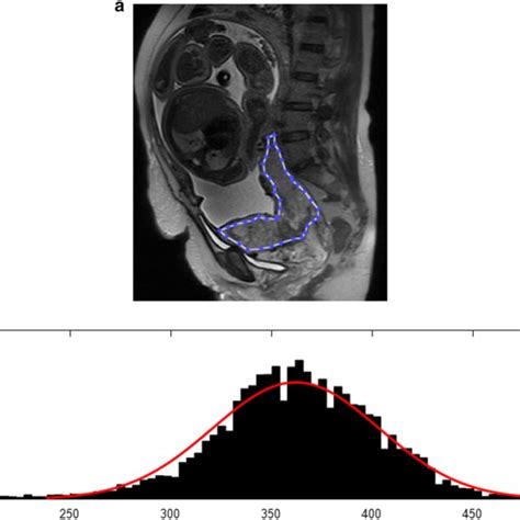 A 35 Year Old Woman With Placenta Increta A Sagittal T2 Mr Image Download Scientific Diagram