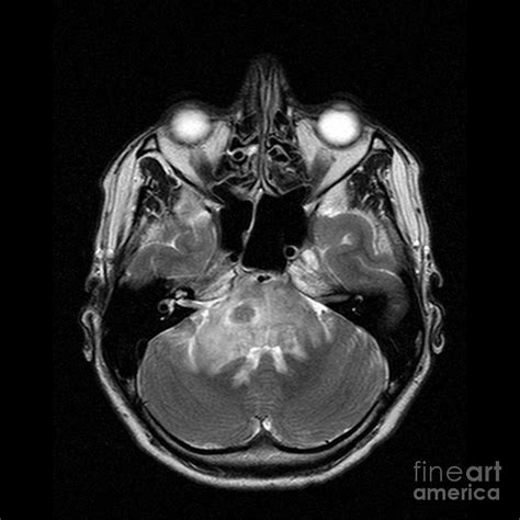 Brain Tumour 40 By Simon Fraser Science Photo Library