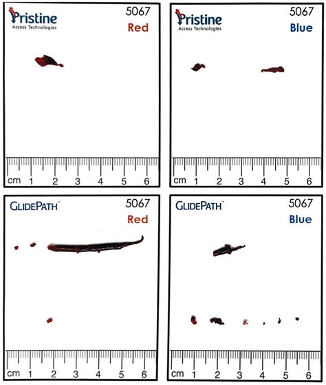 Clot Accumulation At The Tip Of Hemodialysis Catheters In A Large