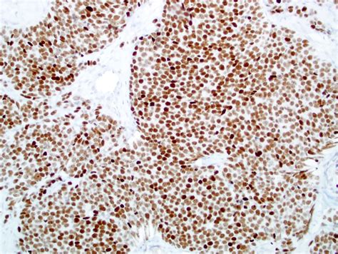 Pathology Outlines INSM1