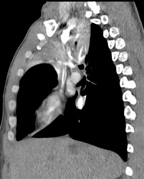 186lu Right Upper Lobe Collapse Lungs