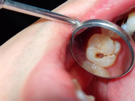 Dealing With Dental Cavities Causes Treatment And Prevention Dent Ally