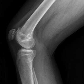 Lateral Radiograph Of The Right Knee Demonstrating Patellar Tunnels