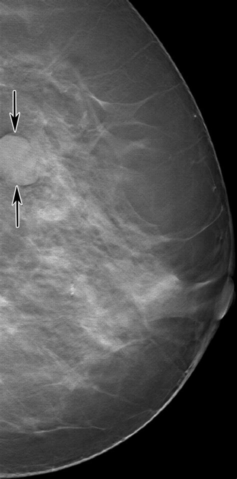 Breast Tomosynthesis Present Considerations And Future Applications Radiographics