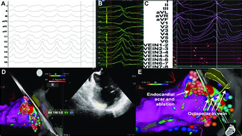 Electrocardiogram Ecg Pace Map And Electroanatomic Mapping Eam