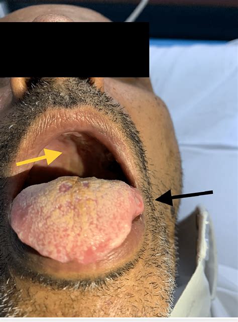 Hard Palate Lesions Yellow Arrow And Ulcer On The Left Lateral Tongue Download Scientific