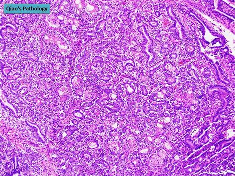 Qiao S Pathology Malignant Phyllodes Tumor Of The Breast With Squamous