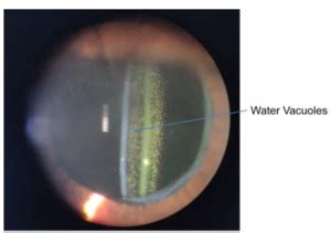 A Review Of Posterior Capsular Opacification Published In CRO